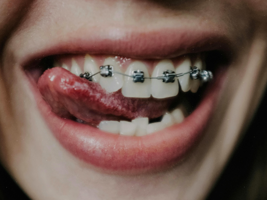 Is Invisalign More Effective Than Braces?
