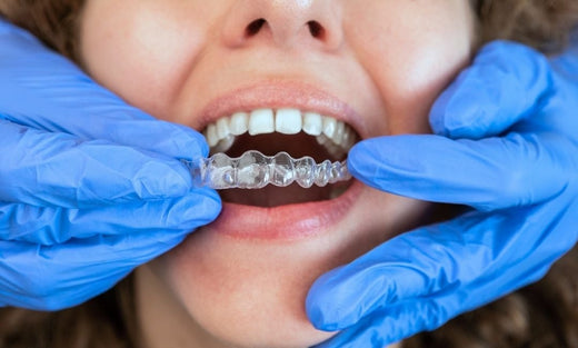 How Long Does Invisalign Take | Dental Movemints